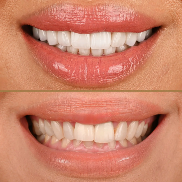 Benefits of Veneers Benefits of Veneers