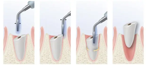 Gentler Extractions Using Revolutionary Piezosonic Gentler Extractions Using Revolutionary Piezosonic